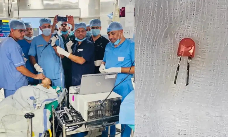 सेना के डॉक्टरों ने रचा इतिहास, 9 महीने के बच्चे के फेफड़े में फंसा LED बल्ब सुरक्षित निकाला